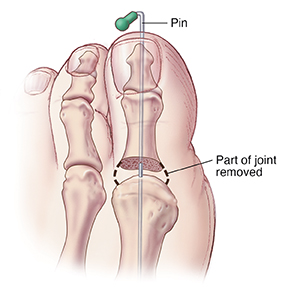 Top view of big toe with pin through top of toe holding bones apart after joint partially removed.