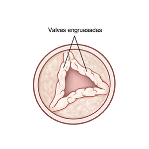 Vista superior de válvula aórtica abierta con aletas engrosadas.